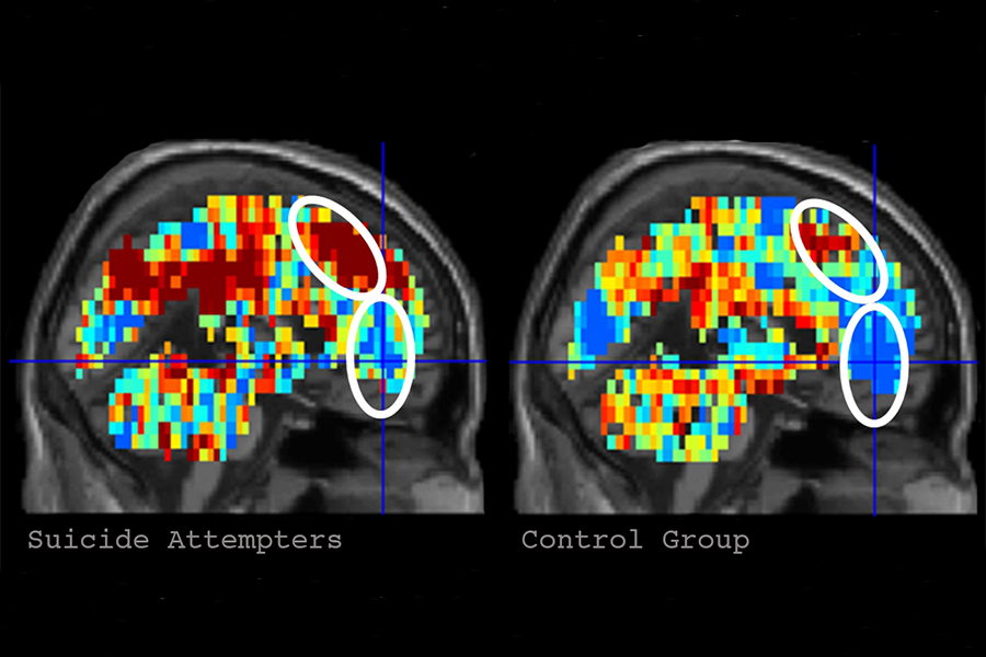 Brain Imaging Science Identifies Individuals With Suicidal Thoughts