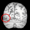 Brain Lesions