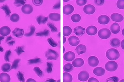 Sickle Cell Blood Cells