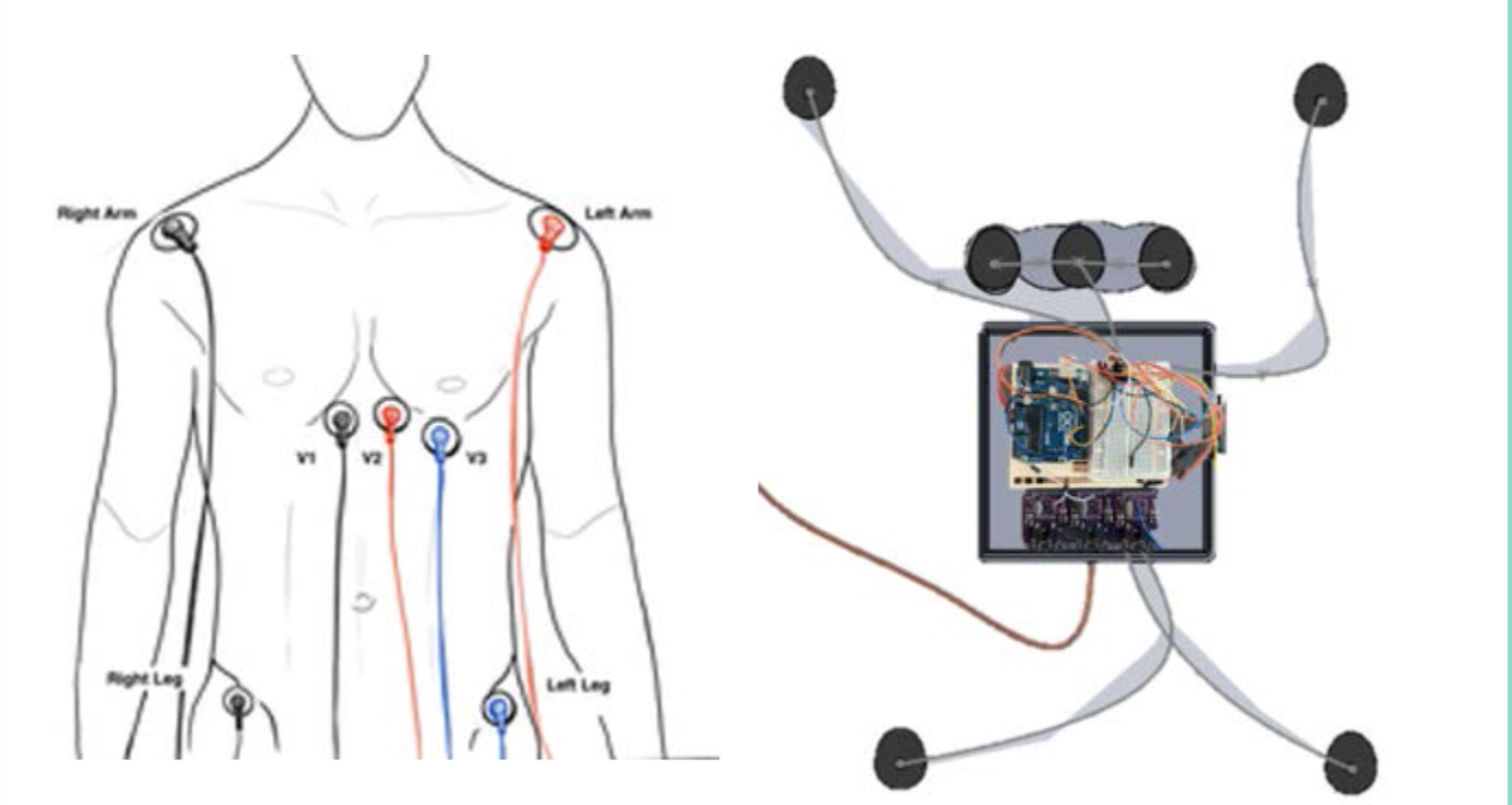 ecg