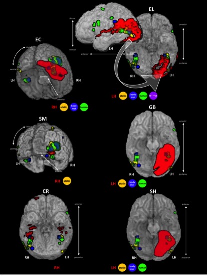 Figure showing brain activation patterns