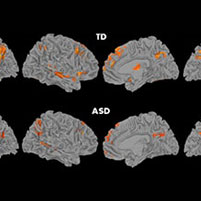 Brain Circuitry Fails To Connect in Children With Autism