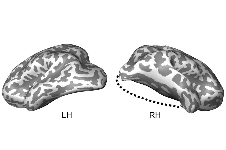 Case Study: Child’s Lobectomy Reveals Brain’s Ability To Reorganize Its Visual System