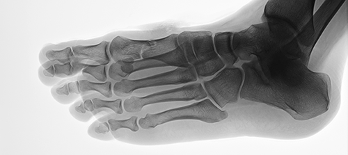 foot xray