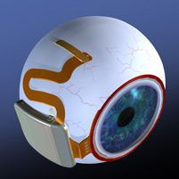 Bionic Eye