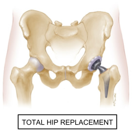 total hip replacement