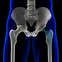 orthopedic interfaces