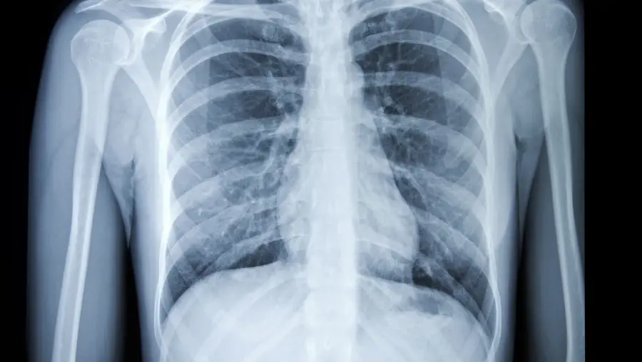 An X-ray of a torso.