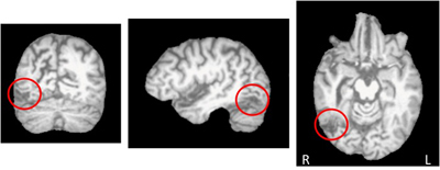 Brain Lesions