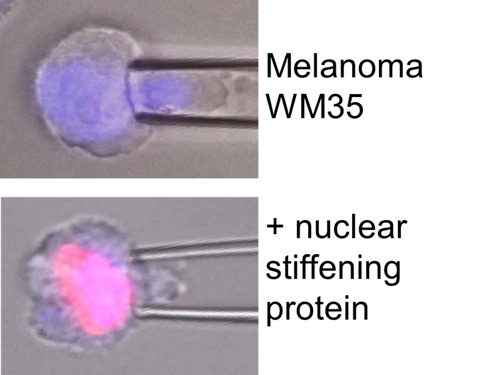 Melanoma Image