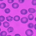 Sickle Cell Blood Cells