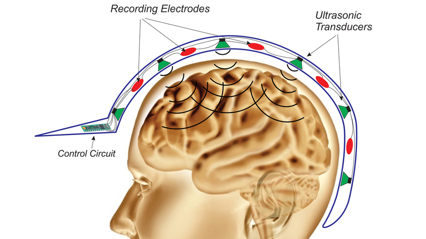 Seizure suppression graphic